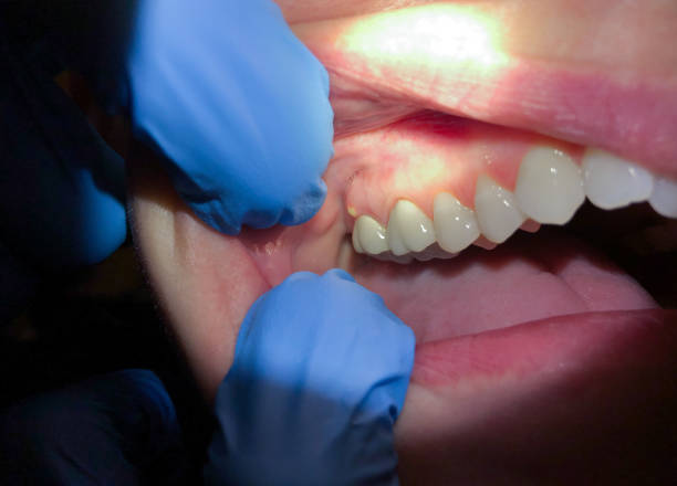 Best Dentist for Tooth Abscess  in Dickson, TN